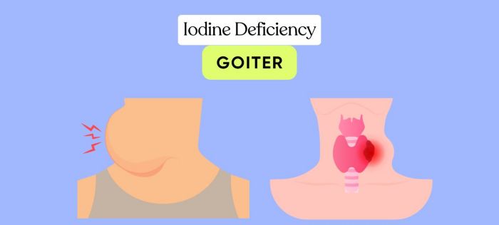 Iodine Deficiency (Goiter)