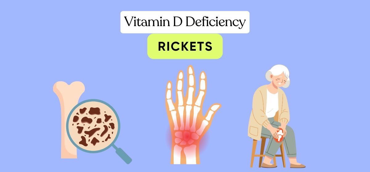 Vitamin D Deficiency (Rickets)