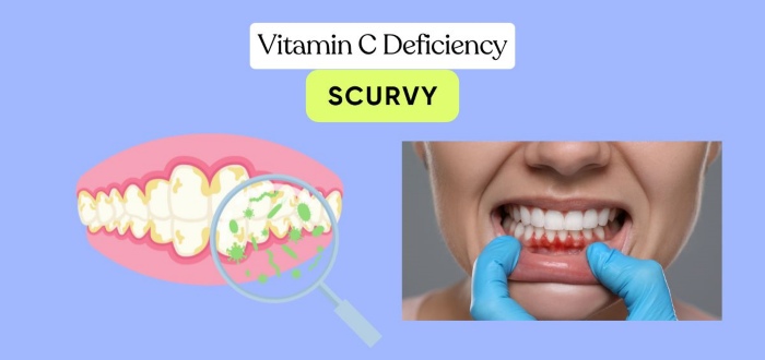 Vitamin C Deficiency (Scurvy)