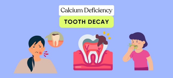 Calcium Deficiency (Tooth decay)